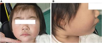 Clinical manifestations in a Chinese girl with heterozygous de novo NAA10 variant c. 247C > T, p. (Arg83Cys): a case report